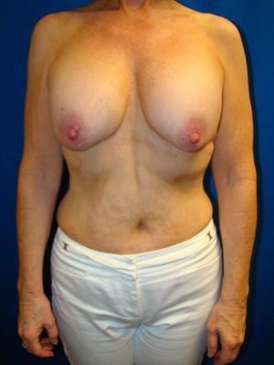 Saggy breast 55-64 - 112 Pics 