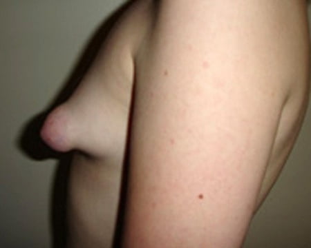 Puffy And Malformed Tits Lovely Areolas Plastic Surgery Pics Xhamster