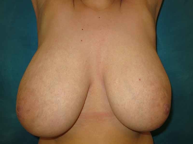 Breast reduction surgery after mastectomy-7916