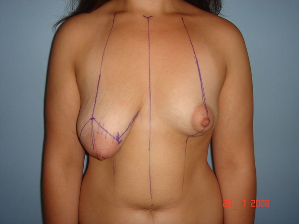 Erotic Abnormal Breasts XXX Album