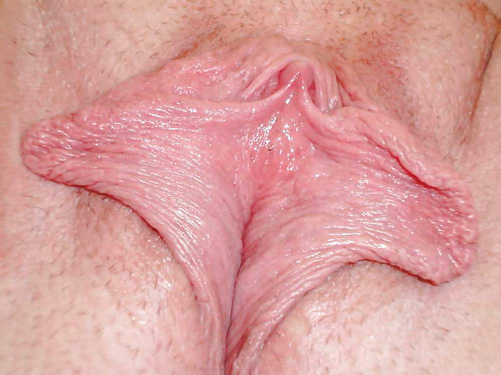 Swollen vagina or vulva